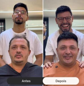antes-e-depois-de-um-implante-capilar--davidX (1)