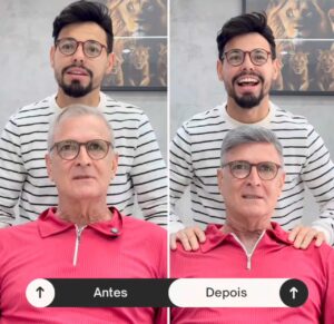 antes-e-depois-de-um-implante-capilar--davidX (10)