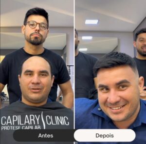 antes-e-depois-de-um-implante-capilar--davidX (3)