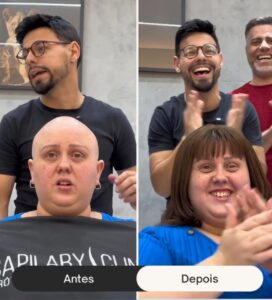 antes-e-depois-de-um-implante-capilar--davidX (4)