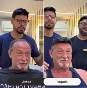 antes-e-depois-de-um-implante-capilar--davidX (5)