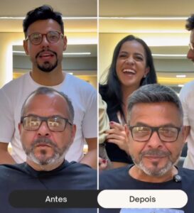 antes-e-depois-de-um-implante-capilar--davidX (6)