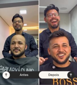 antes-e-depois-de-um-implante-capilar--davidX (7)