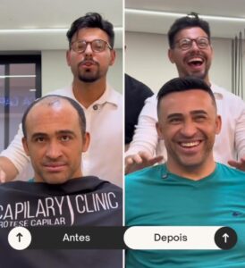 antes-e-depois-de-um-implante-capilar--davidX (8)