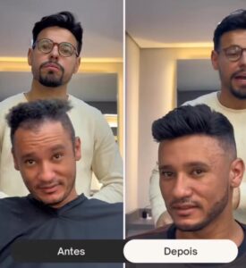 antes-e-depois-de-um-implante-capilar--davidX (9)